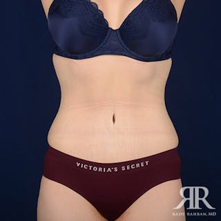 Tummy Tuck Before & After Gallery - Patient 168367 - Image 2