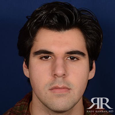 Male Rhinoplasty Before & After Gallery - Patient 175371 - Image 1