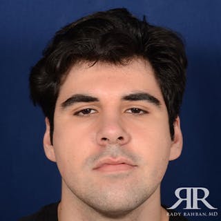 Male Rhinoplasty Before & After Gallery - Patient 175371 - Image 2