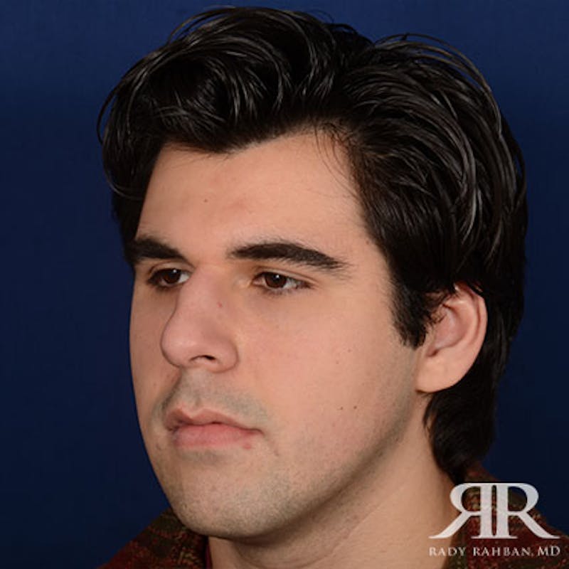 Male Rhinoplasty Before & After Gallery - Patient 175371 - Image 3