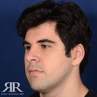 Male Rhinoplasty Before & After Gallery - Patient 175371 - Image 4