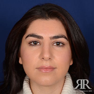 Female Rhinoplasty Before & After Gallery - Patient 228905 - Image 2