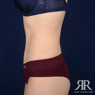 Tummy Tuck Before & After Gallery - Patient 168367 - Image 6