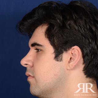 Male Rhinoplasty Before & After Gallery - Patient 175371 - Image 6