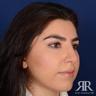 Female Rhinoplasty Before & After Gallery - Patient 228905 - Image 4