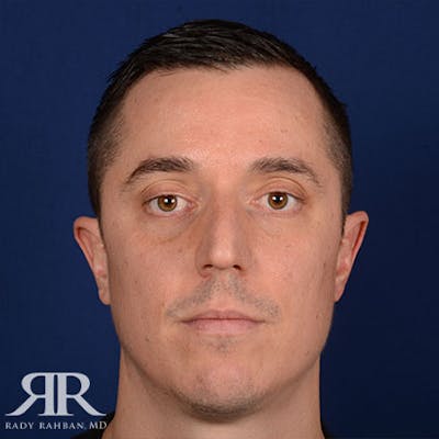 Male Rhinoplasty Before & After Gallery - Patient 428280 - Image 1