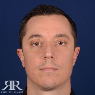 Male Rhinoplasty Before & After Gallery - Patient 428280 - Image 2