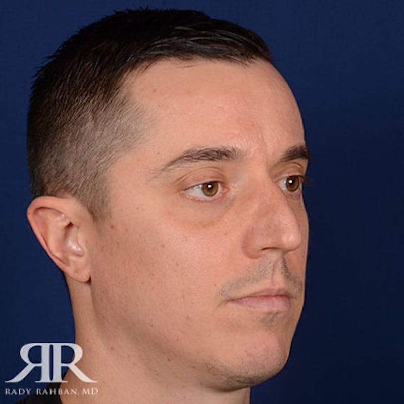 Male Rhinoplasty Before & After Gallery - Patient 428280 - Image 3