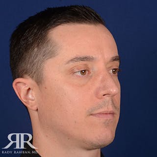 Male Rhinoplasty Before & After Gallery - Patient 428280 - Image 4