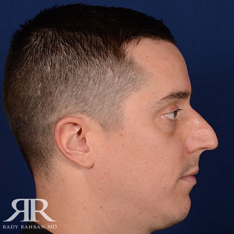 Male Rhinoplasty Before & After Gallery - Patient 428280 - Image 5