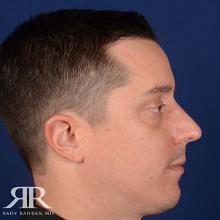 Male Rhinoplasty Before & After Gallery - Patient 428280 - Image 6