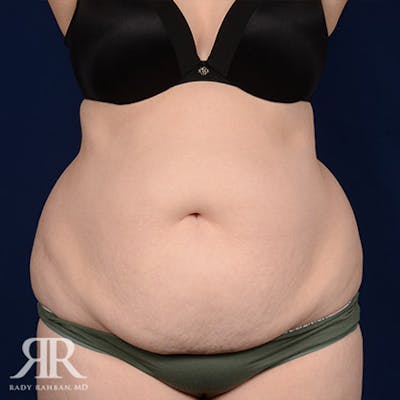 Tummy Tuck Before & After Gallery - Patient 217001 - Image 1