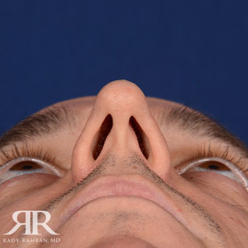 Male Rhinoplasty Before & After Gallery - Patient 428280 - Image 7