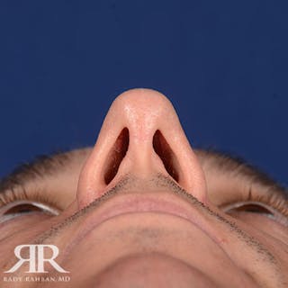 Male Rhinoplasty Before & After Gallery - Patient 428280 - Image 8