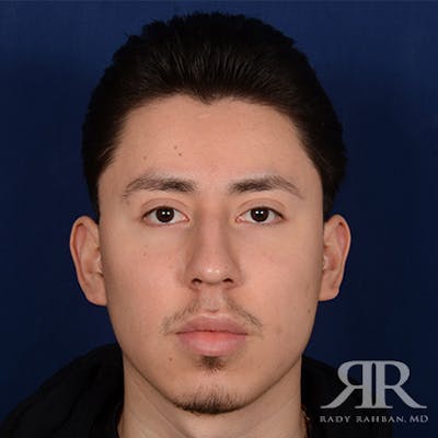 Male Rhinoplasty Before & After Gallery - Patient 168342 - Image 1