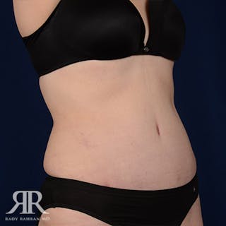 Tummy Tuck Before & After Gallery - Patient 217001 - Image 4
