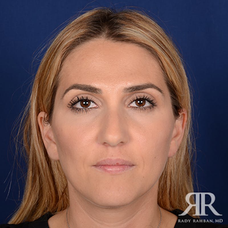 Female Rhinoplasty Before & After Gallery - Patient 150596 - Image 1