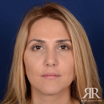 Female Rhinoplasty Before & After Gallery - Patient 150596 - Image 2