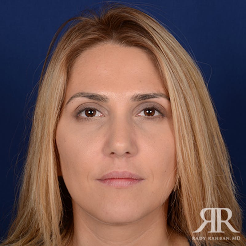 Female Rhinoplasty Before & After Gallery - Patient 150596 - Image 2