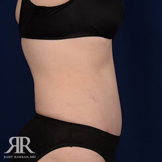 Tummy Tuck Before & After Gallery - Patient 217001 - Image 6