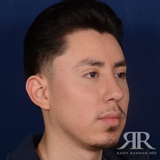 Male Rhinoplasty Before & After Gallery - Patient 168342 - Image 4