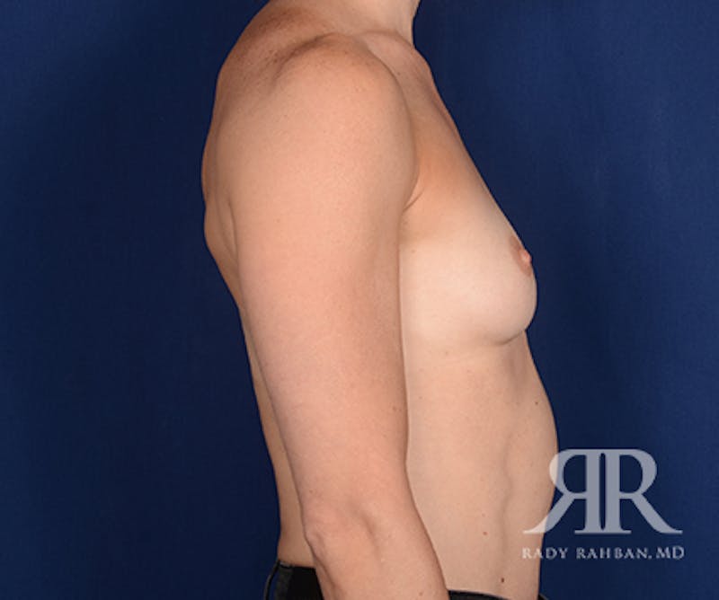 Breast Augmentation Before & After Gallery - Patient 546946 - Image 5