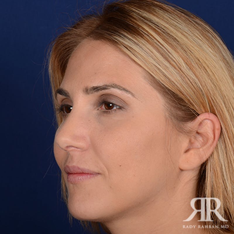 Female Rhinoplasty Before & After Gallery - Patient 150596 - Image 4