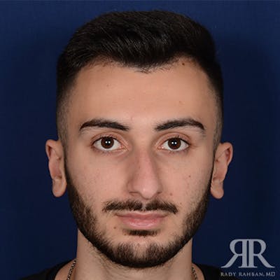 Male Rhinoplasty Before & After Gallery - Patient 380735 - Image 1