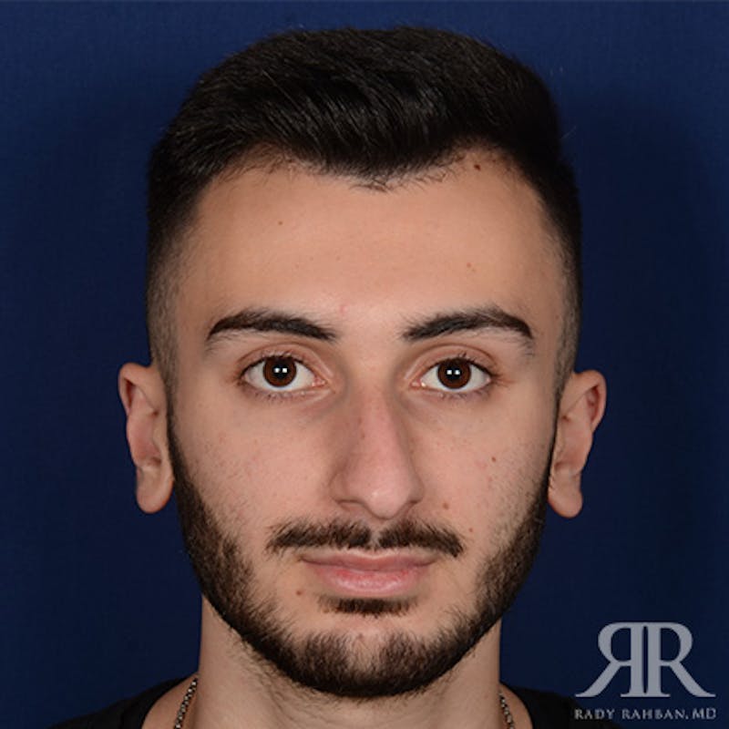 Male Rhinoplasty Before & After Gallery - Patient 380735 - Image 1