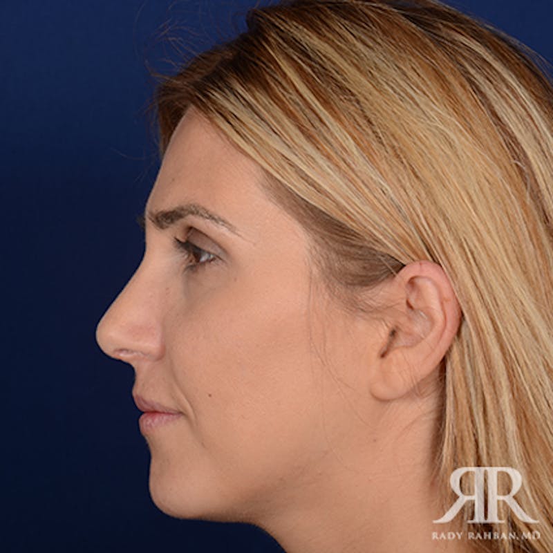 Female Rhinoplasty Before & After Gallery - Patient 150596 - Image 6