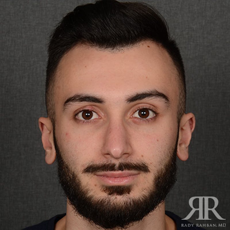 Male Rhinoplasty Before & After Gallery - Patient 380735 - Image 2