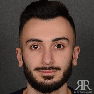 Male Rhinoplasty Before & After Gallery - Patient 380735 - Image 2