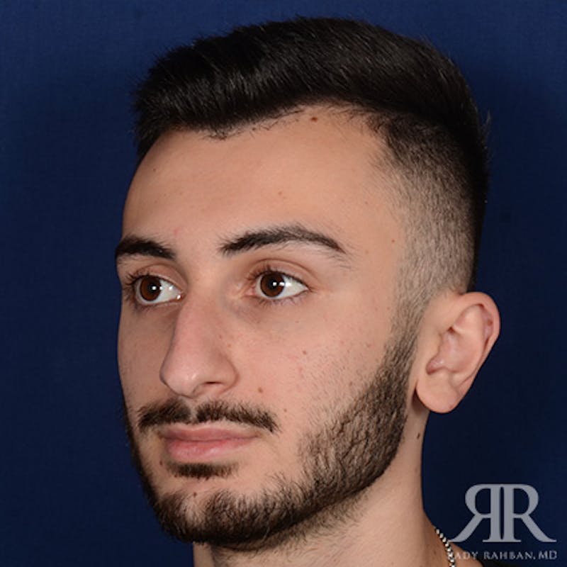 Male Rhinoplasty Before & After Gallery - Patient 380735 - Image 3
