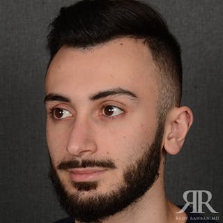 Male Rhinoplasty Before & After Gallery - Patient 380735 - Image 4