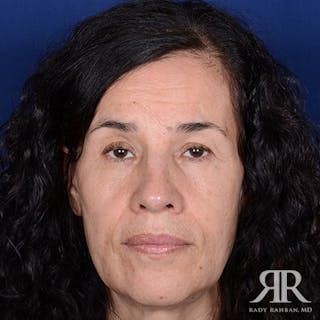 Female Rhinoplasty Before & After Gallery - Patient 299378 - Image 2