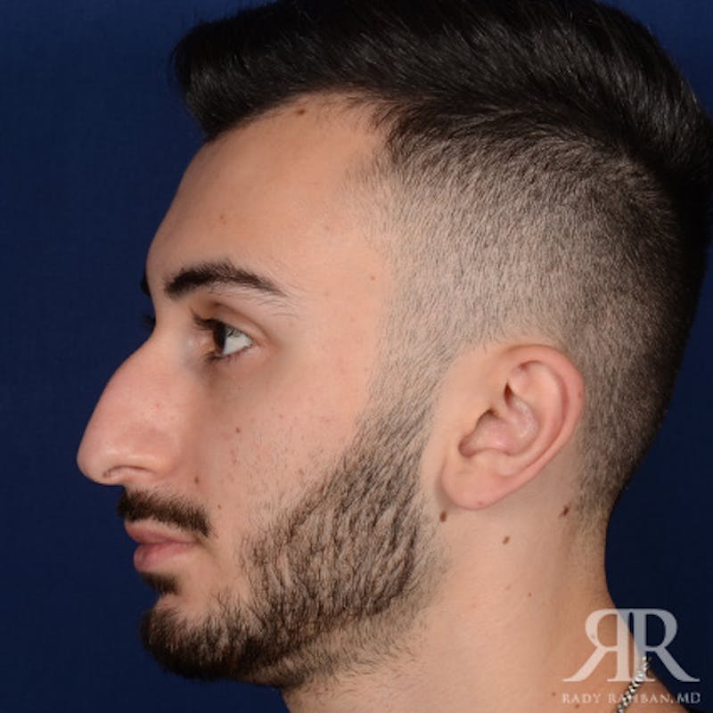 Male Rhinoplasty Before & After Gallery - Patient 380735 - Image 5