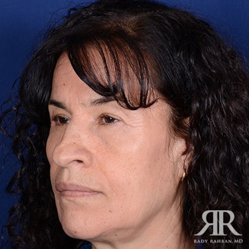 Female Rhinoplasty Before & After Gallery - Patient 299378 - Image 3