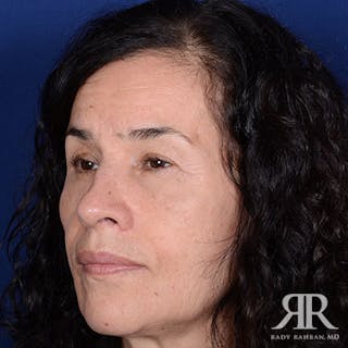 Female Rhinoplasty Before & After Gallery - Patient 299378 - Image 4