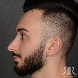 Male Rhinoplasty Before & After Gallery - Patient 380735 - Image 6