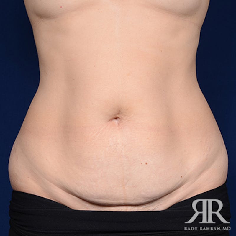 Tummy Tuck Before & After Gallery - Patient 222423 - Image 1