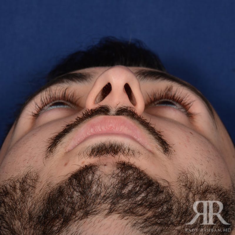 Male Rhinoplasty Before & After Gallery - Patient 380735 - Image 7