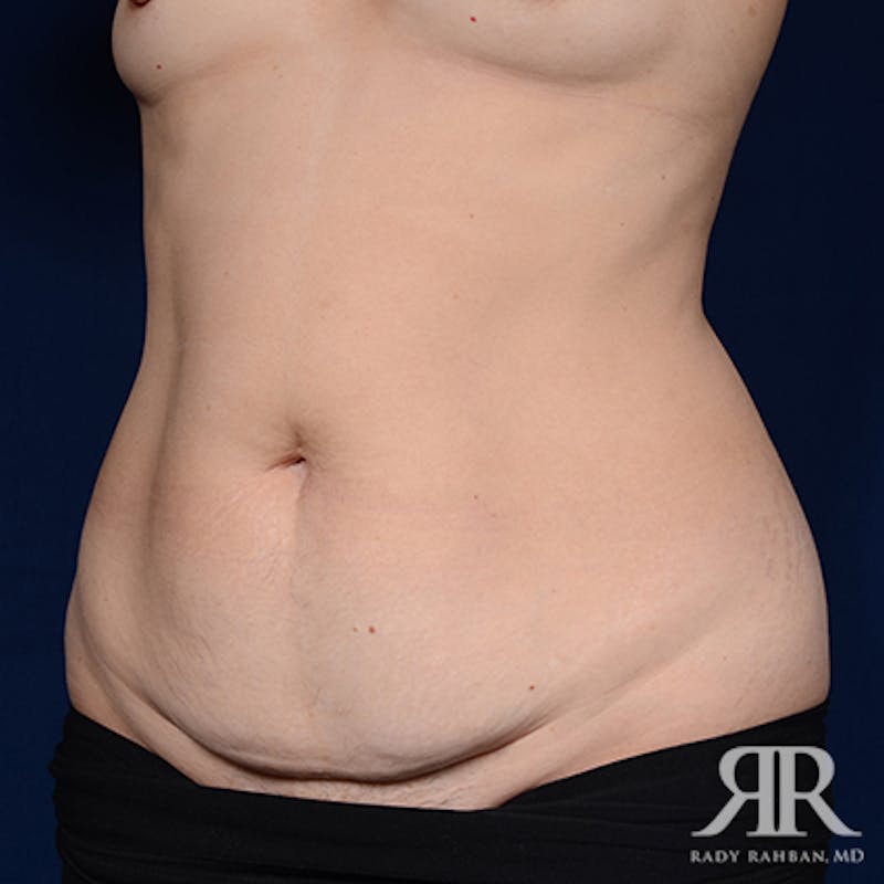 Tummy Tuck Before & After Gallery - Patient 222423 - Image 3