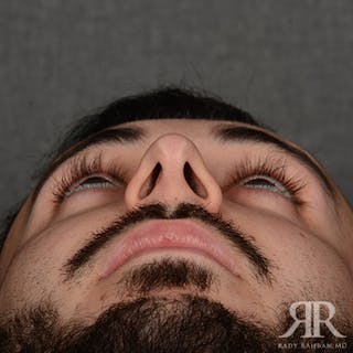 Male Rhinoplasty Before & After Gallery - Patient 380735 - Image 8