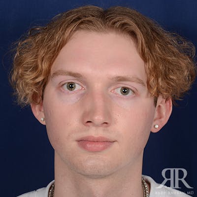 Male Rhinoplasty Before & After Gallery - Patient 149522 - Image 1