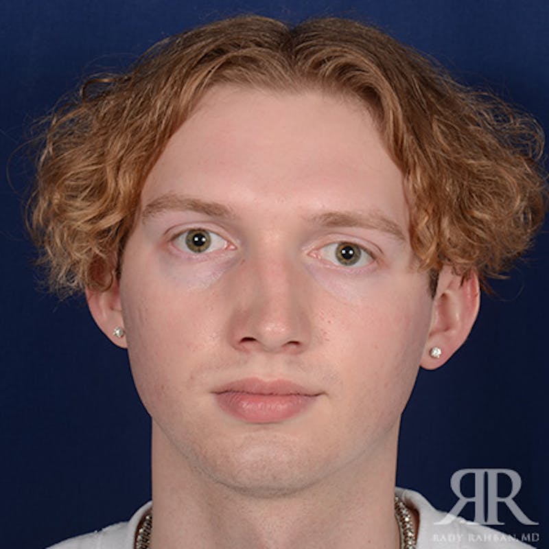 Male Rhinoplasty Before & After Gallery - Patient 149522 - Image 1