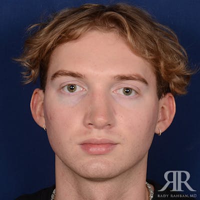 Male Rhinoplasty Before & After Gallery - Patient 149522 - Image 2