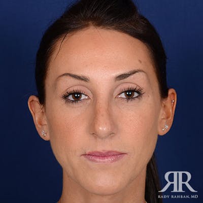 Female Rhinoplasty Before & After Gallery - Patient 160749 - Image 2
