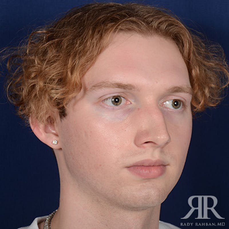Male Rhinoplasty Before & After Gallery - Patient 149522 - Image 3