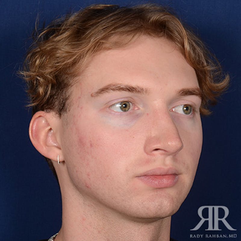 Male Rhinoplasty Before & After Gallery - Patient 149522 - Image 4