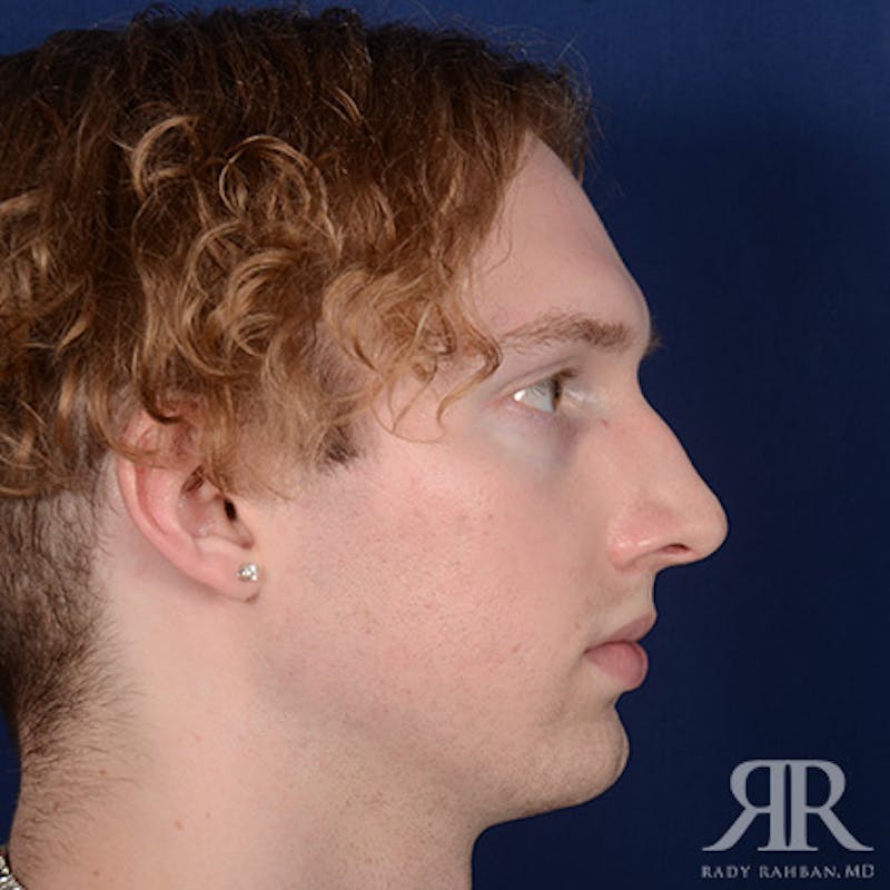 Male Rhinoplasty Before & After Gallery - Patient 149522 - Image 5